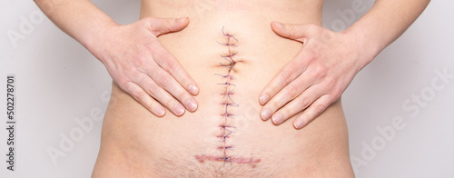 Surgical stitches. Surgical wound on body. Ileus abdomen surgery