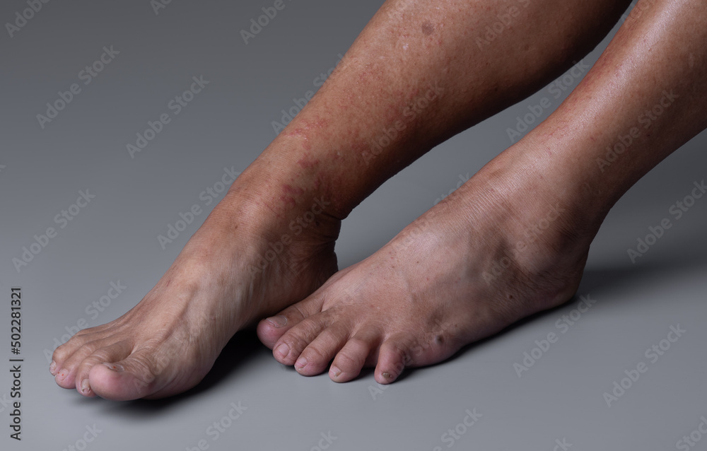 Strong allergic rashes on the leg on gray background , Dermatological rash on the skin and body The problem of health and cosmetology. Immune System Disease, Allergy Strong allergic rashes on the leg on gray background , Dermatological rash on the skin and body The problem of health and cosmetology. Immune System Disease, Allergy