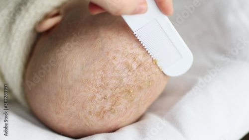 removing seborrheic dandruff flakes crusts off newborn baby child head with white comb. close-up view of infant's kid seborrhea dermatitis in hair. medical skin problem, combing and exfoliation photo