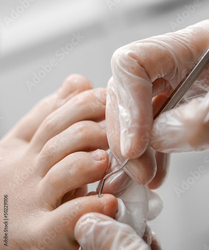 Φωτογραφία medical pedicure of problem feet of a person