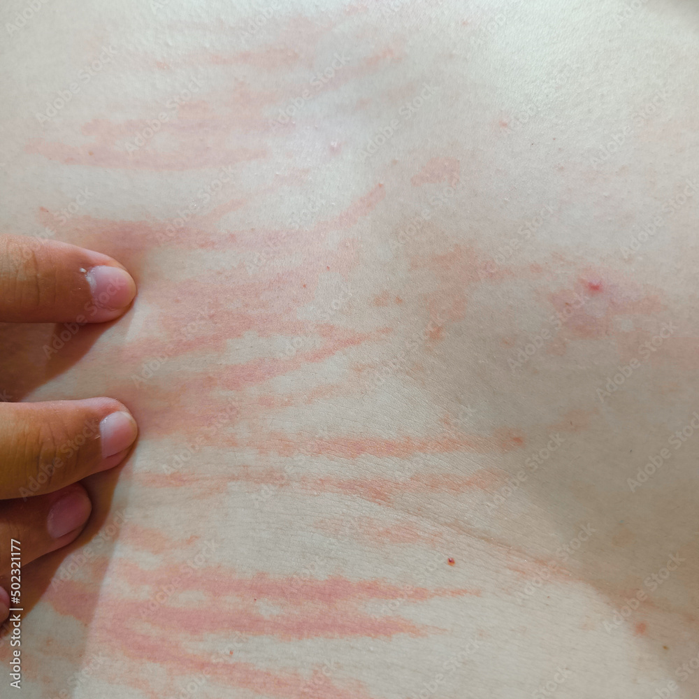 Scratch scars on the skin of a white Asian man Scratch scars on the skin of a white Asian man