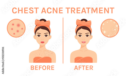 Brunette Woman with Problem Skin on Chest. Before and After. Red Pimples and Acne Rash. Treatment of Skin of Decollete. Color Cartoon style. White background. Vector illustration for Medical design.