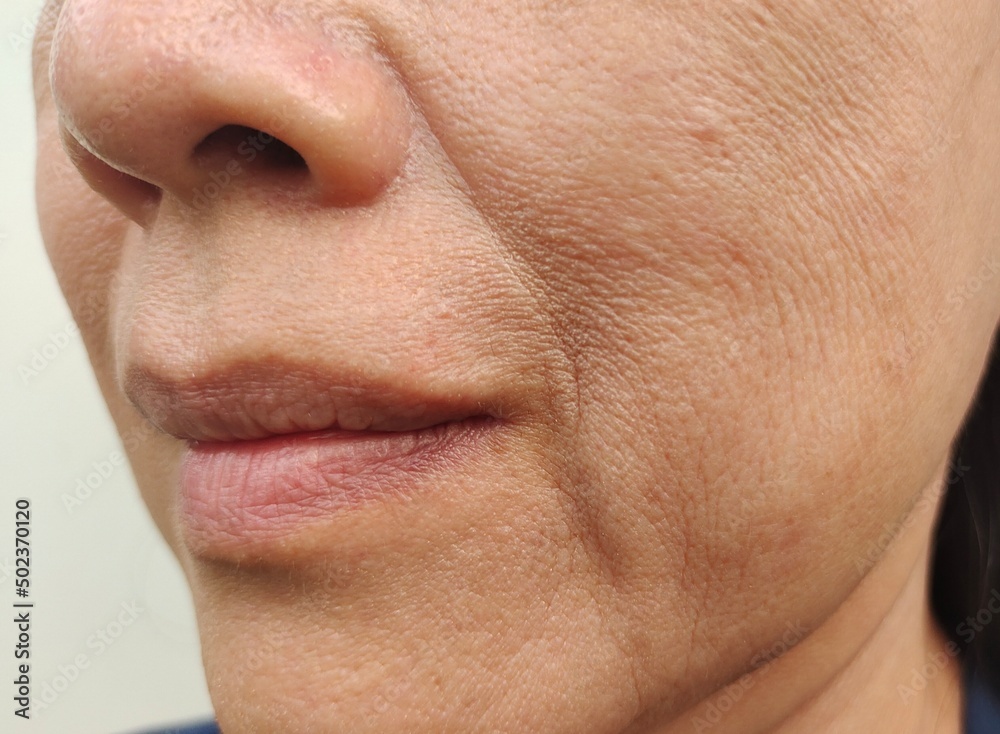 close up portrait flabbiness adipose beside the mouth, problem wrinkles and sagging skin on the face of the woman, concept health care. close up portrait flabbiness adipose beside the mouth, problem wrinkles and sagging skin on the face of the woman, concept health care.
