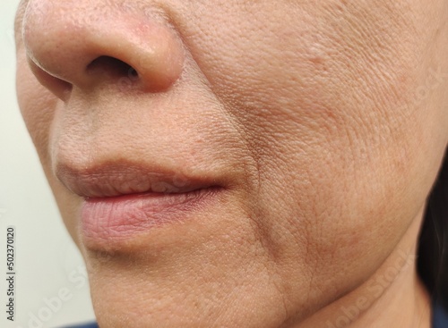 close up portrait flabbiness adipose beside the mouth  problem wrinkles and sagging skin on the face of the woman  concept health care.