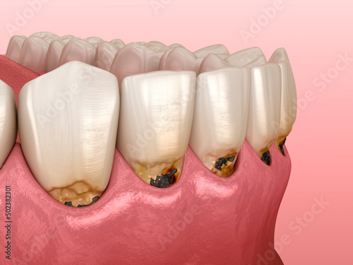 Cervical caries on frontal teeth. Dental 3D illustration