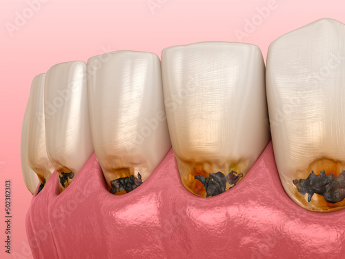 Cervical caries on frontal teeth. Dental 3D illustration photo