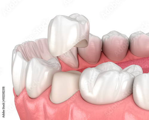 Preparated premolar tooth and dental crown placement. Dental 3D illustration