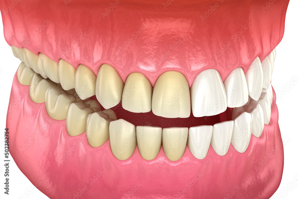 Obraz premium Teeth whitening - before and after. Dental 3D illustration