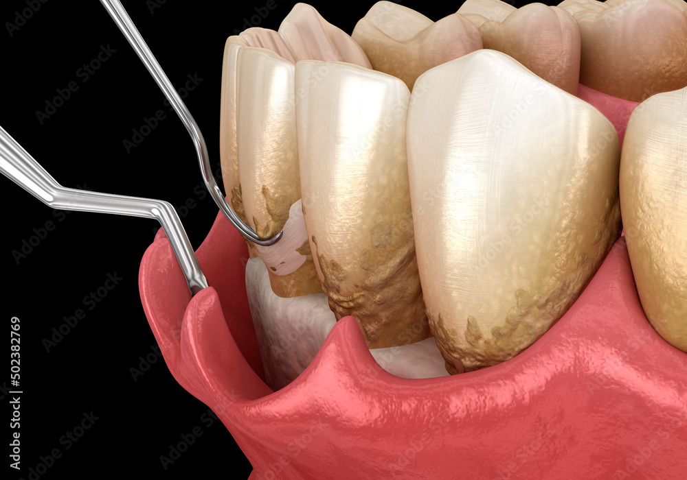 Open curettage Scaling and root planing (conventional periodontal