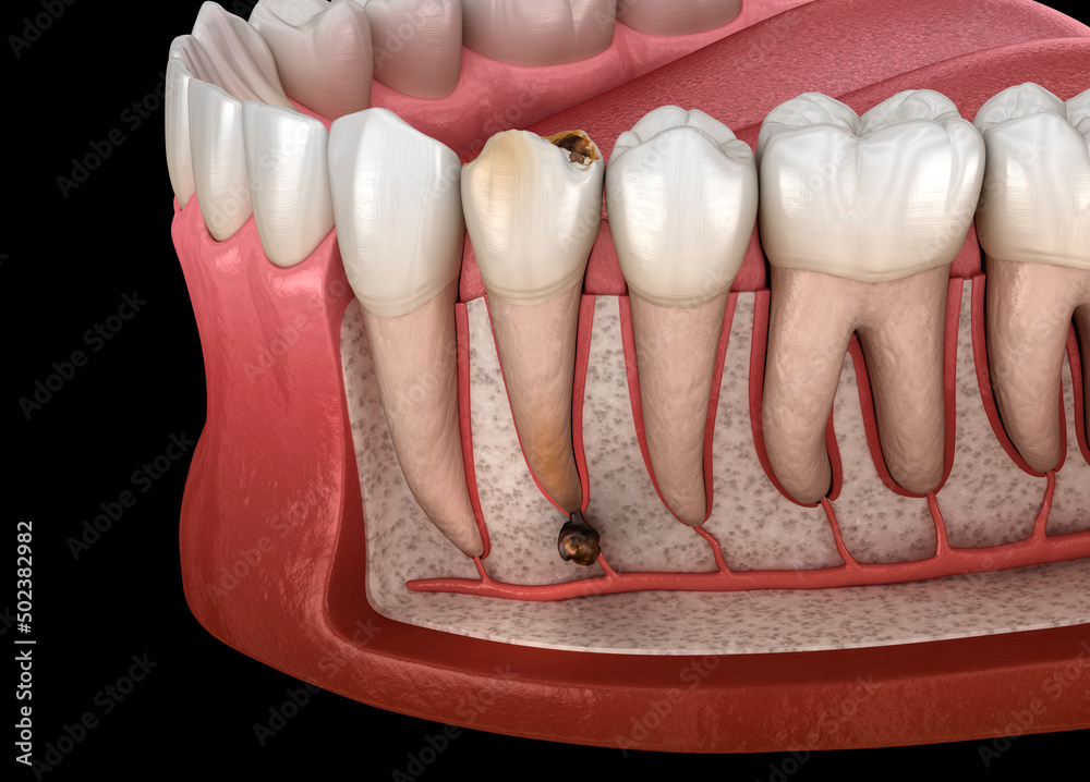 Periostitis tooth Lump on Gum Above Tooth. Dental dental 3D
