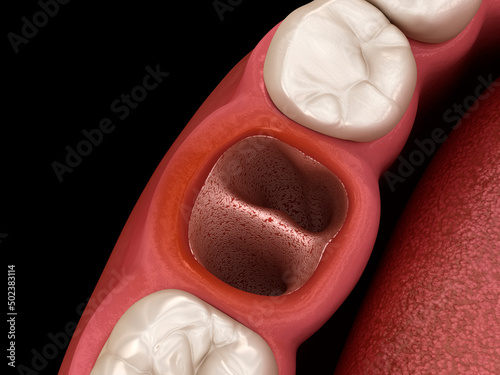 Alveolits - opened dry soket after tooth extraction. Dental 3D illustration photo