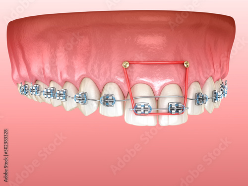 Elastics and metal braces for correction overbite of frontal incisors. Dental 3D illustration photo