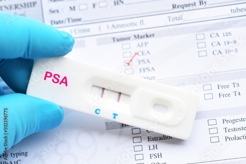 PSA positive by using rapid test cassette, prostate cancer diagnosis