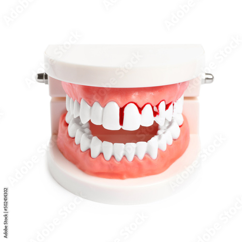 Model of jaw with blood on teeth against white background. Gum problems