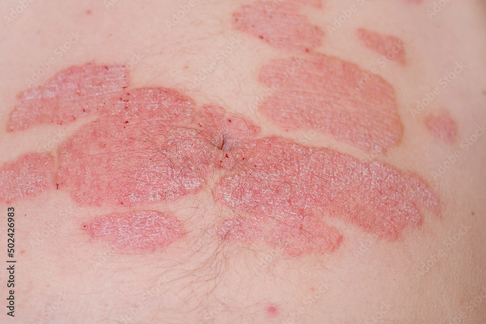 Fotka „Large red inflamed scaly rash on the stomach.Acute psoriasis on