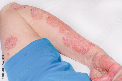Acute psoriasis on the arm of a man, severe redness on the skin, an autoimmune incurable dermatological skin disease. Red redness, spots on the skin.Large red inflamed scaly rash on the hands. photo