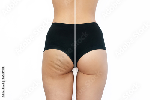 Close-up of female buttocks with cellulite before and after treatment isolated on a white background. Getting rid of excess weight, diet, healthy nutrition, training, sports, massage, scrub. Wellness