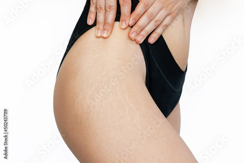 Cropped shot of a young woman in black panties demonstrating white stretch marks from a weight loss or weight gain on her thigh isolated on a white background. Cosmetology, beauty concept