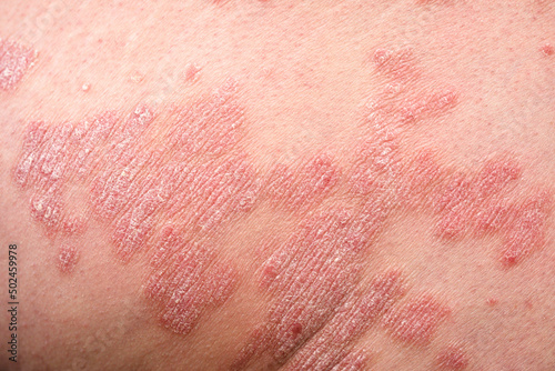 Close up part of human skin affected by psoriasis photo