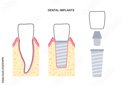 Dental implant procedure