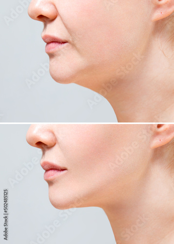 Obraz na plátně Female nasolabial fold before and after wrinkle smoothing procedures