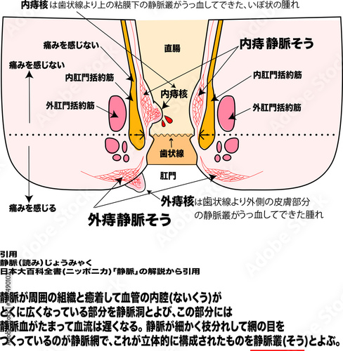 痔のメカニズムと肛門断面イラストと説明図