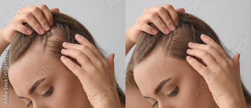 Fotografija Woman before and after hair loss treatment on grey background, closeup