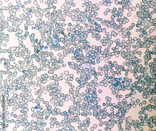 Microscopic view of abnormal reticulocyte count in hematology department, methylene blue staining photo