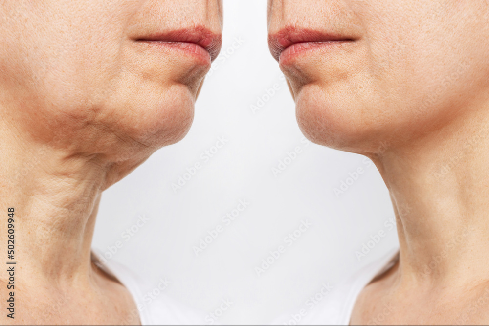 Lower part of face and neck of elderly woman with signs of skin aging before and after facelift, plastic surgery isolated on white background. Age-related changes, flabby sagging skin. Platysmoplasty - obrazy, fototapety, plakaty 