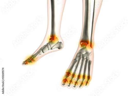 X-ray view of inflamed foot bones photo