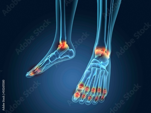 X-ray view of inflamed foot bones