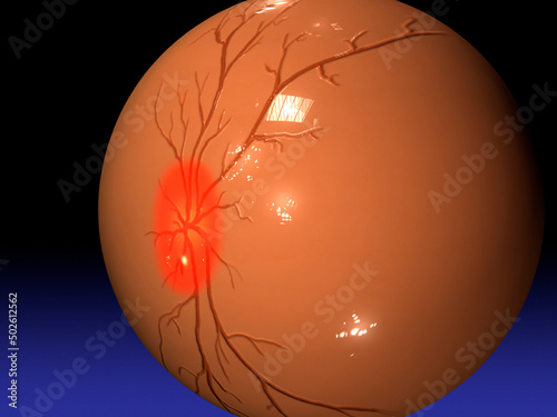 Close-up of the human eyeball with retinal damage caused by glaucoma photo
