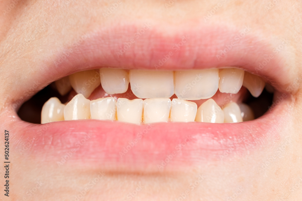 Obraz premium Patient with dislocated jaw and malocclusion, temporomandibular joint dysfunction, close-up.