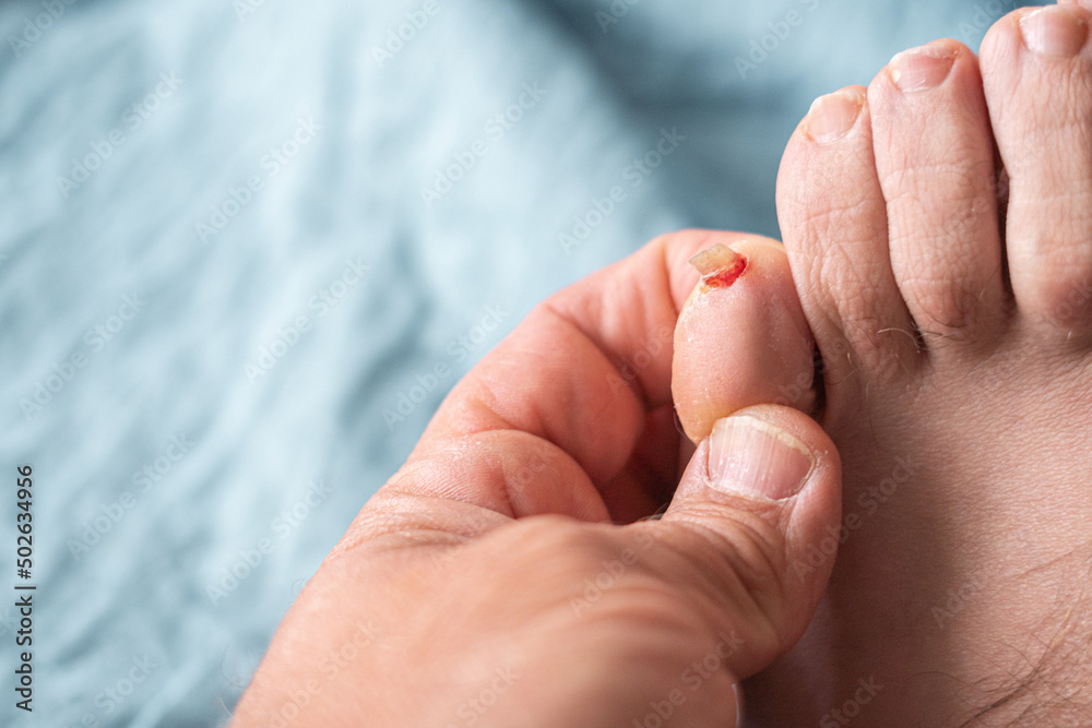 Nail of the little toe, broken and bloody. Nail of the little toe, broken and bloody.