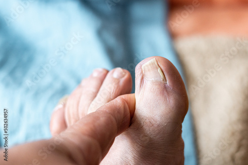 Hallux toe nail, partially broken and ingrown photo