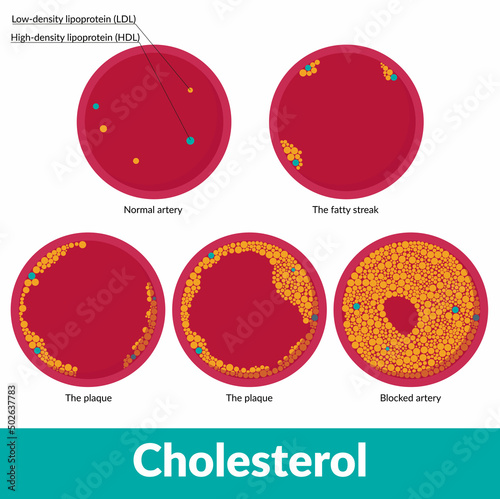 Scheme of clogged artery development with differentiation of low-density and high-density lipoproteins.