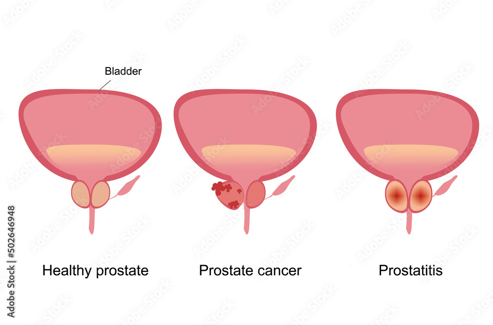 Prostate Block Healthy prostate, prostatitis and prostate cancer. Illustration of male ...