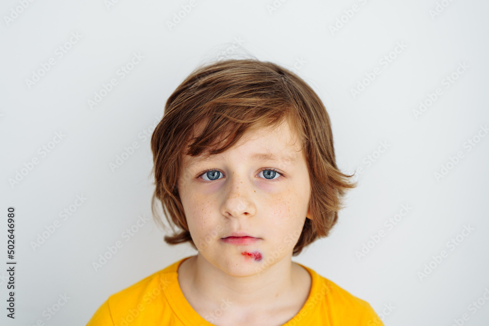 Portrait of school boy kid child with sore bruised wound on his face. Caucasian schoolboy in yellow t-shirt hurt his face. Portrait of school boy kid child with sore bruised wound on his face. Caucasian schoolboy in yellow t-shirt hurt his face.