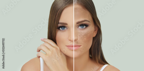Dark spots, freckles,hyperpigmentation(melasma or chloasma),concept - skin lightening, skin whitening, fruit acids,AHA, Skin Brightening.