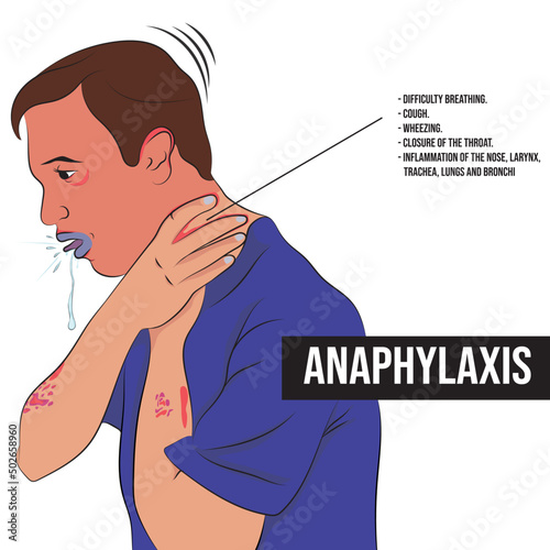 Anaphylaxis, an extremely severe allergic reaction that affects the entire body and sets in within minutes of being exposed to the allergen