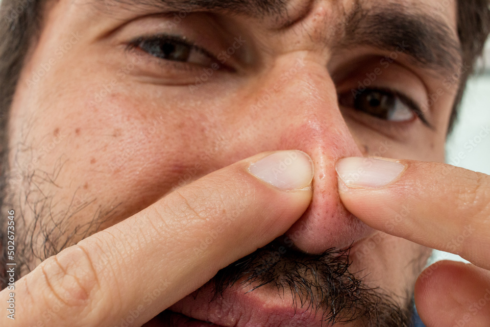 Fototapeta premium Hispanic male squeezing his nose black heads