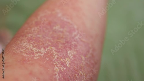Close-up view of the eczema on a person's arm. photo