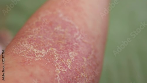 Close-up view of the eczema on a person's arm.