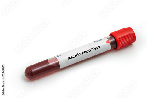 Ascitic Fluid Test Medical check up test tube with biological sample photo