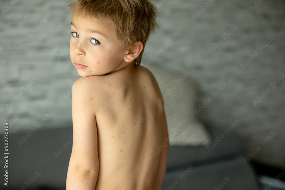 Toddler boy with chicken pox, mild rash, first stage of the disease Toddler boy with chicken pox, mild rash, first stage of the disease