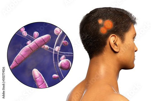 Obraz na plátně Fungal infection on a man's head, 3D illustration