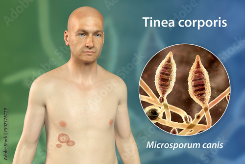 Fungal infection on a man's body. Tinea corporis, 3D illustration photo