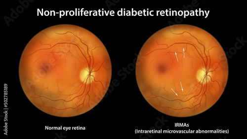 Photos Non-proliferative diabetic retinopathy, illustration