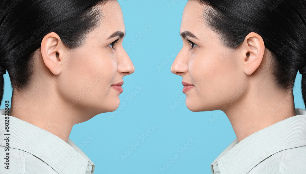 Double chin problem. Collage with photos of young woman before and after plastic surgery procedure on turquoise background Double chin problem. Collage with photos of young woman before and after plastic surgery procedure on turquoise background
