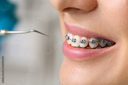 Woman with dental braces visiting dentist in clinic, closeup © Pixel-Shot